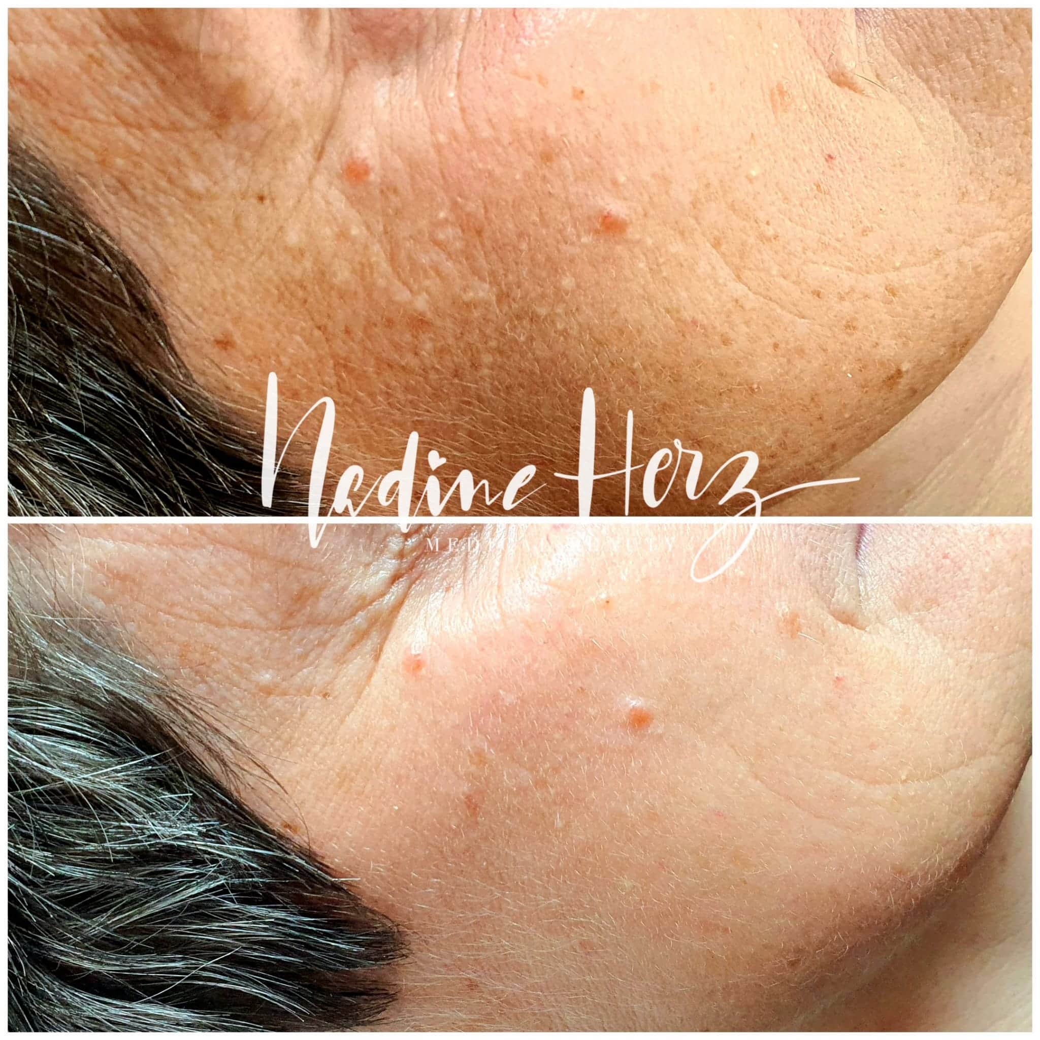 Anti Aging potsdam, Medical Beauty Berlin, fett weg spritze potsdam, Gewichtsreduktion Berlin, dauerhafte haarentfernung potsdam, Saline Krampfaderentfernung, mesotherapie berlin, Lidstraffung Berlin, Fadenlifting Potsdam, Heilpraktikerin, Hyaluronsäure Unterspritzung, IPL, Hautverjüngung