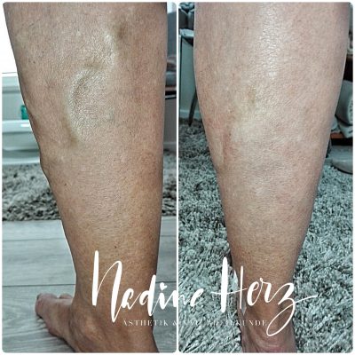 Krampfadern entfernen Berlin, Heilpraktikerin Potsdam, Beauty Potsdam, Nadine Herz, Gewichtsreduktion Berlin, dauerhafte haarentfernung potsdam, Saline Krampfaderentfernung, mesotherapie berlin, Lidstraffung Berlin, Fadenlifting Potsdam, Hyaluronsäure Unterspritzung, IPL, Hautverjüngung, Anti Aging potsdam, Medical Beauty Berlin, fett weg spritze potsdam,
